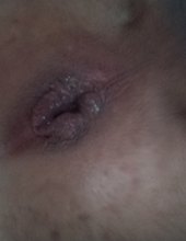 Anal