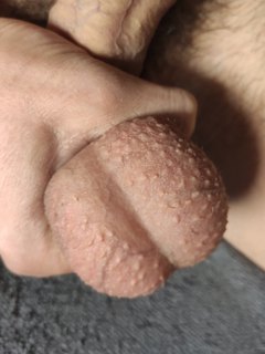 Balls, body or the glans