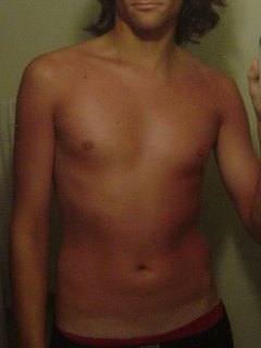 Sunburn